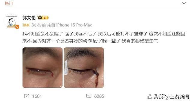 郭艾伦专访首谈眼睛手术煎熬过程：每一针都清晰感受，视力逐渐恢复